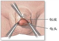 包皮过长危害了谁的健康